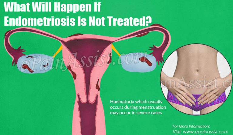 What Will Happen If Endometriosis Is Not Treated?