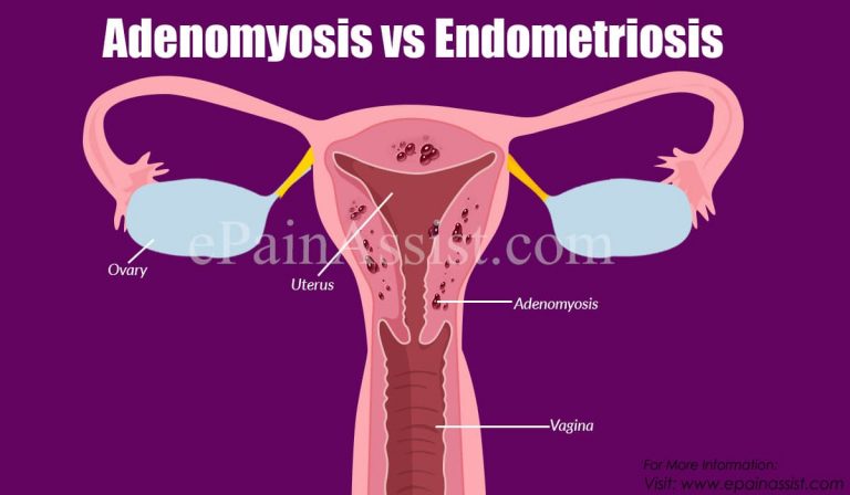 Adenomyosis vs Endometriosis: Differences Based on Causes, Symptoms, Treatments, Diagnosis