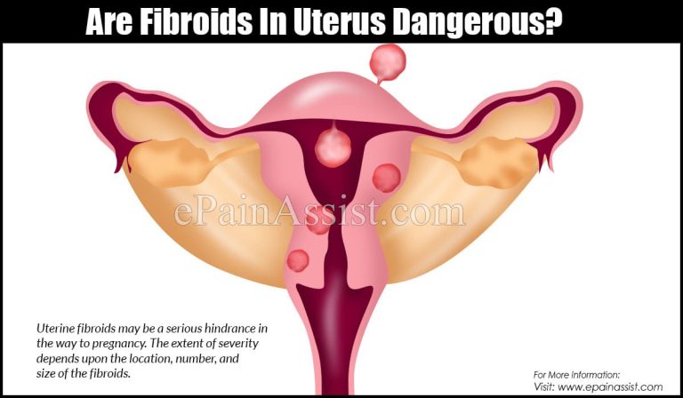 Are Fibroids In Uterus Dangerous?