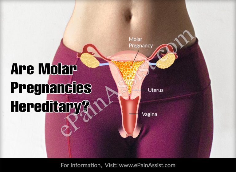 Are Molar Pregnancies Hereditary?