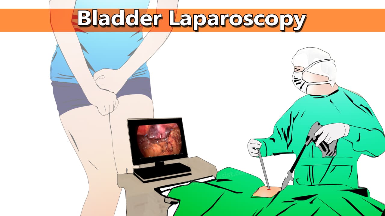 Bladder Laparoscopy