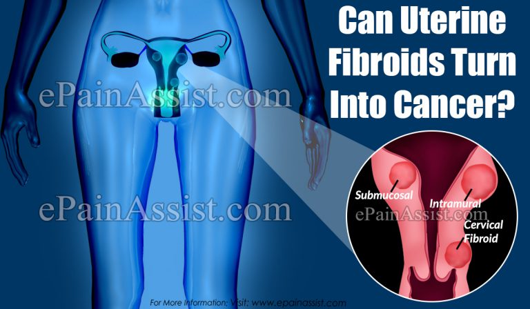Can Uterine Fibroids Turn Into Cancer?