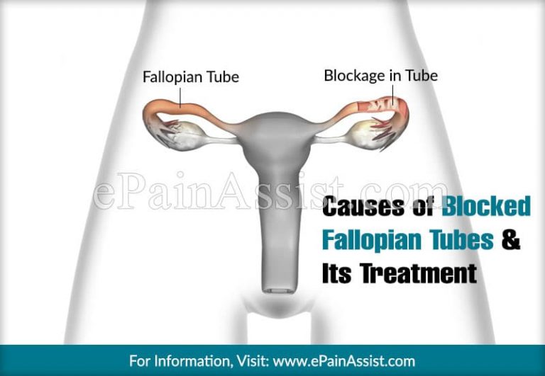 Causes of Blocked Fallopian Tubes & Its Treatment