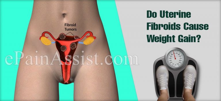 Do Uterine Fibroids Cause Weight Gain?