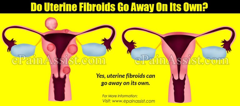 Do Uterine Fibroids Go Away On Its Own?