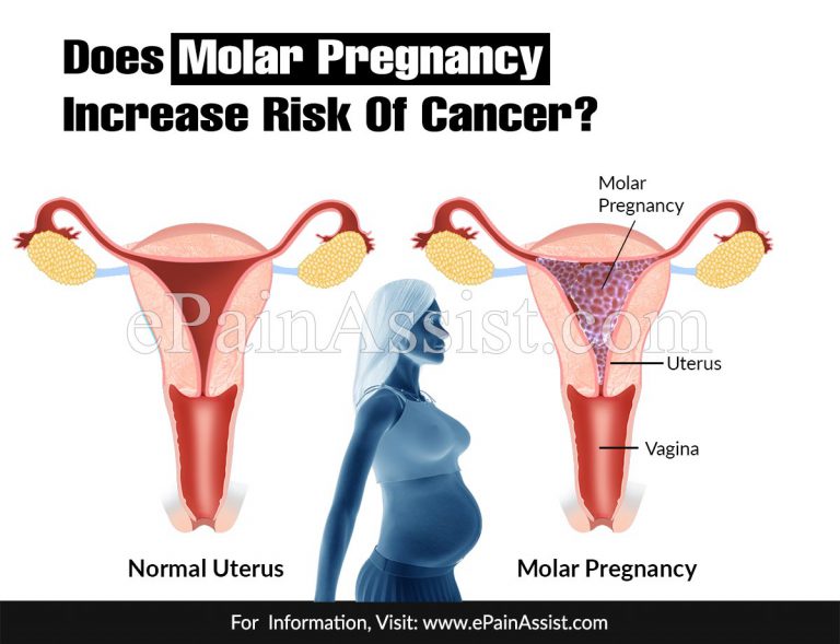 Does Molar Pregnancy Increase Risk Of Cancer?