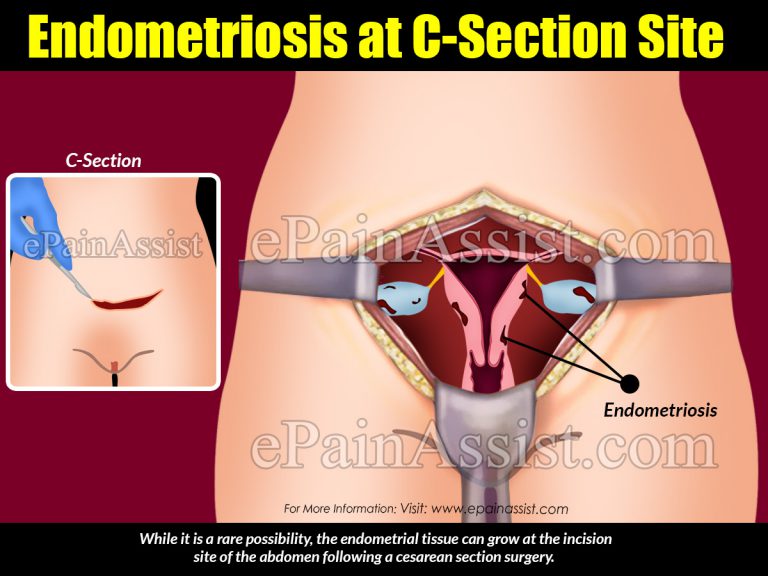 Symptoms of Endometriosis at C-Section Site & Its Treatment, Diagnosis