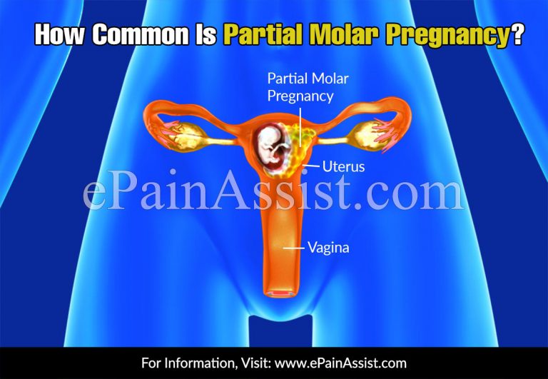 How Common Is Partial Molar Pregnancy?