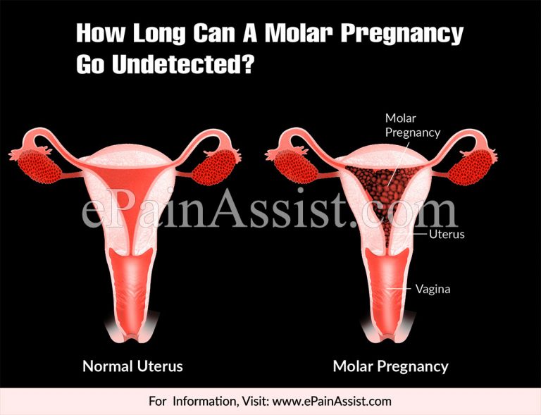 How Long Can A Molar Pregnancy Go Undetected?
