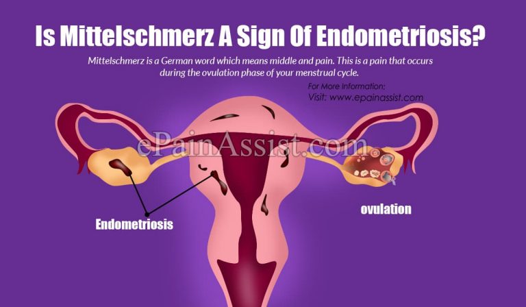 Is Mittelschmerz A Sign Of Endometriosis?