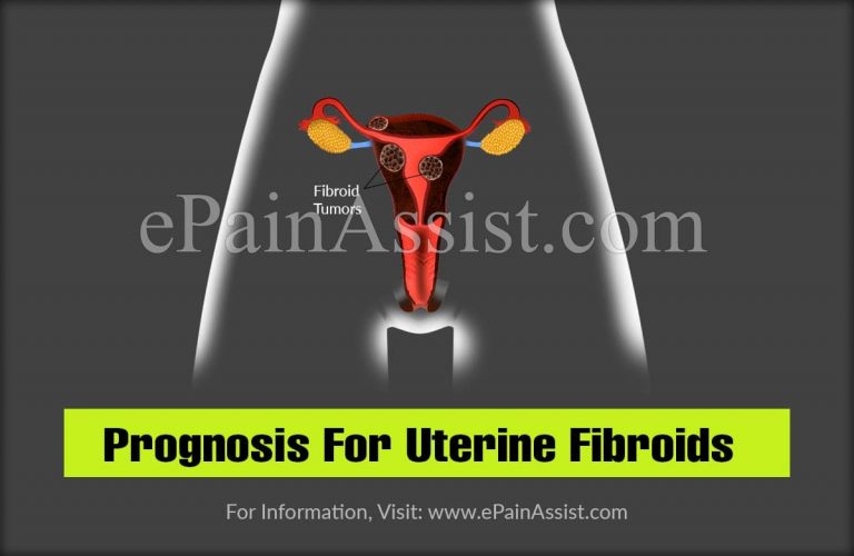 Prognosis For Uterine Fibroids
