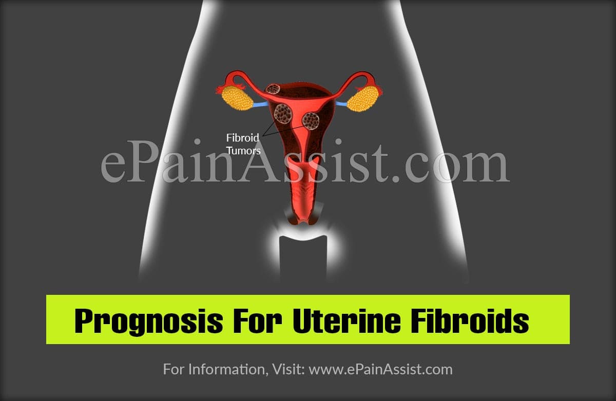 Prognosis For Uterine Fibroids