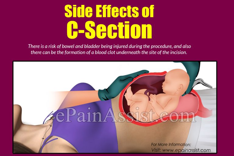 Side Effects of C- Section Vs Natural Birth