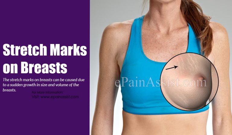 Stretch Marks On Breasts: Causes & Natural Remedies To Get Rid of it
