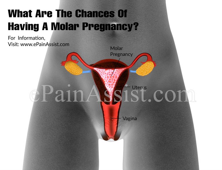 What Are The Chances Of Having A Molar Pregnancy?