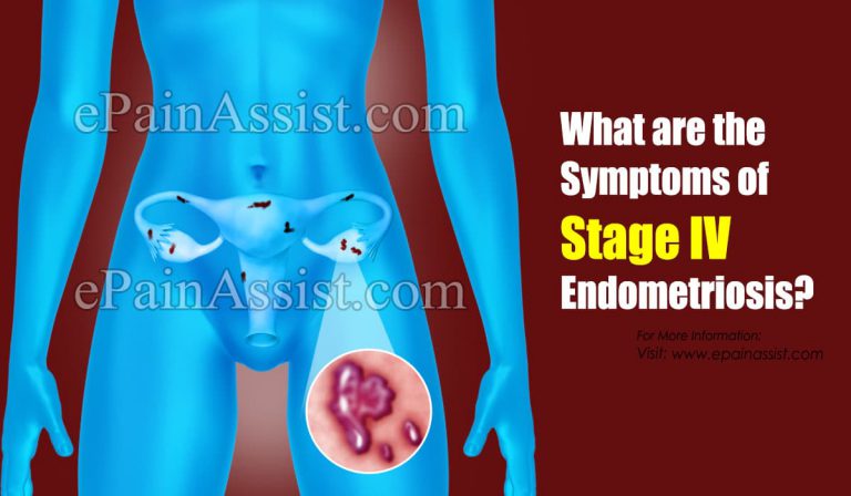 What are the Symptoms of Stage IV Endometriosis and its Treatment Options?