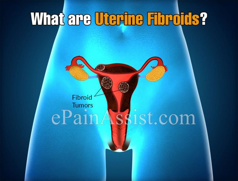 What are Uterine Fibroids, Know its Types, Causes, Symptoms, Treatment, Prognosis, Complications