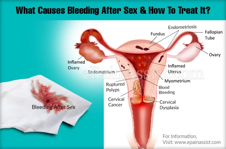 What Causes Bleeding After Sex & How Is It Treated?