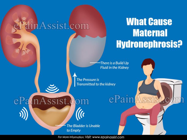 What Causes Maternal Hydronephrosis?
