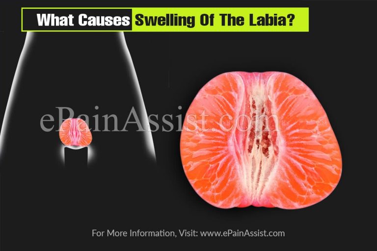 What Causes Swelling Of The Labia And How Is it Treated?