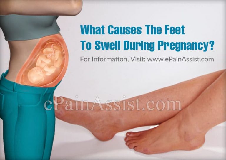 Swollen Feet During Pregnancy: Causes & Relief Measures