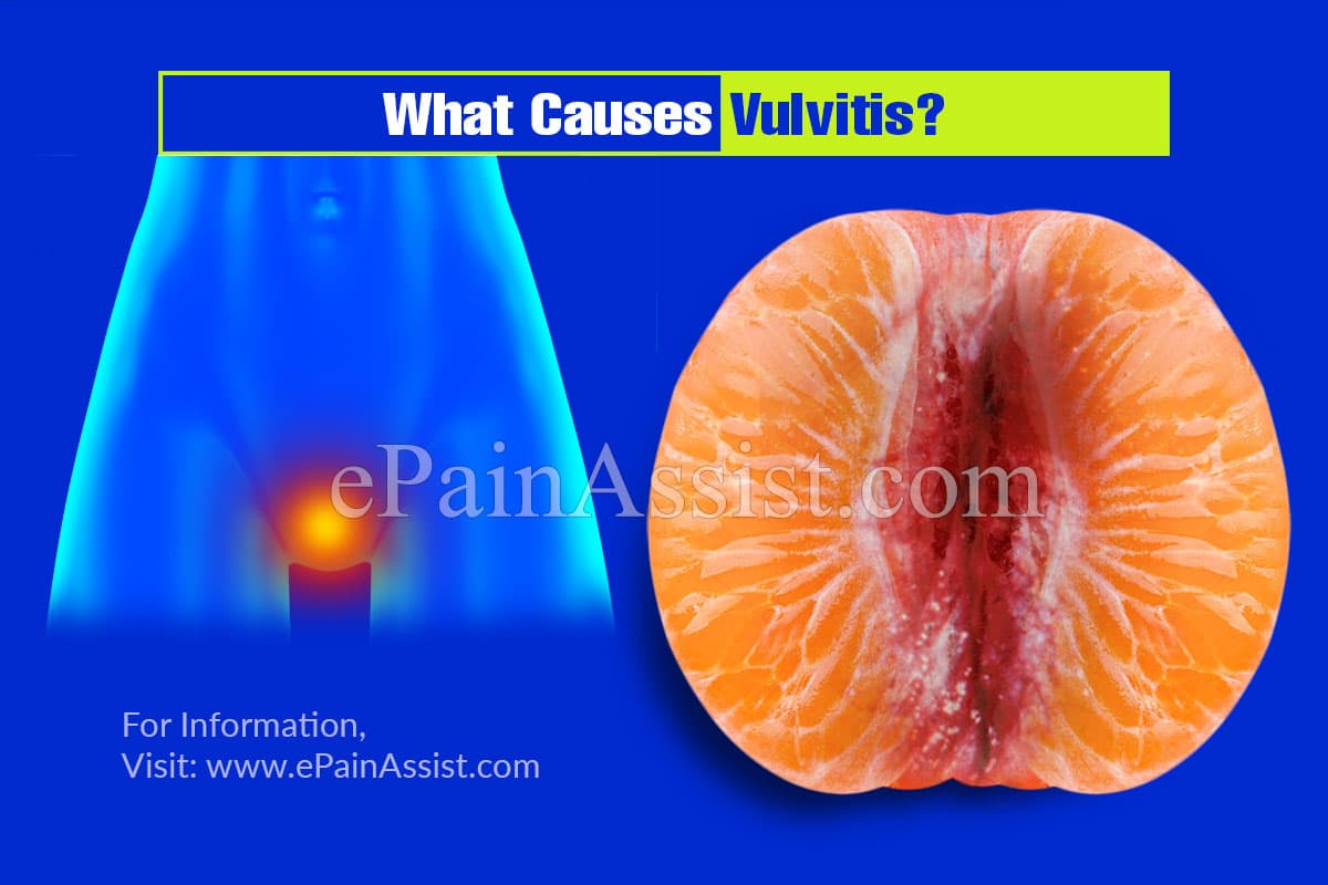 What Causes Vulvitis?