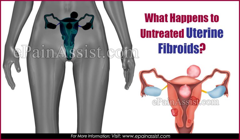 What Happens to Untreated Uterine Fibroids?