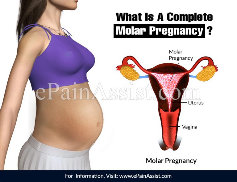 What Is A Complete Molar Pregnancy?