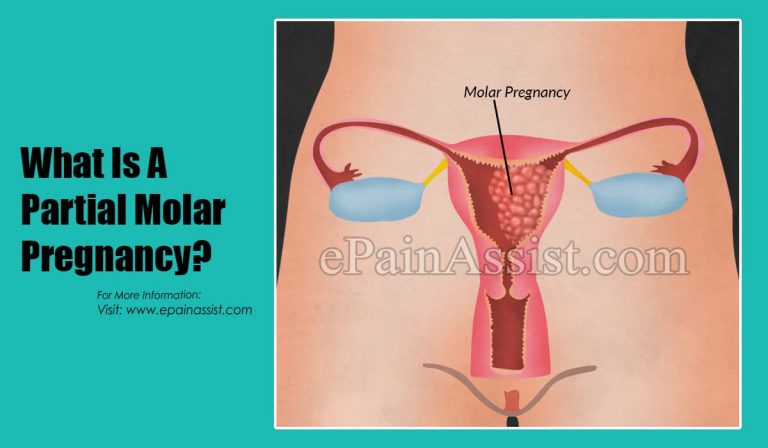 What Is A Partial Molar Pregnancy?