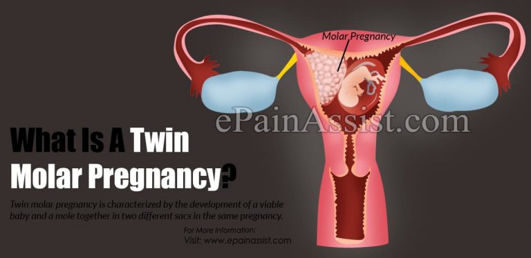 What Is A Twin Molar Pregnancy?