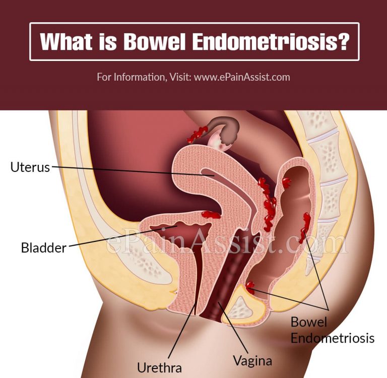 What is Bowel Endometriosis: Causes, Symptoms, Treatment