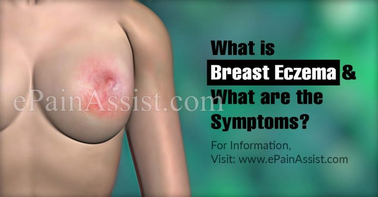 Breast Eczema: Symptoms, Treatment, Could Breast Eczema Be Mistaken For Paget’s Disease of the Breast?