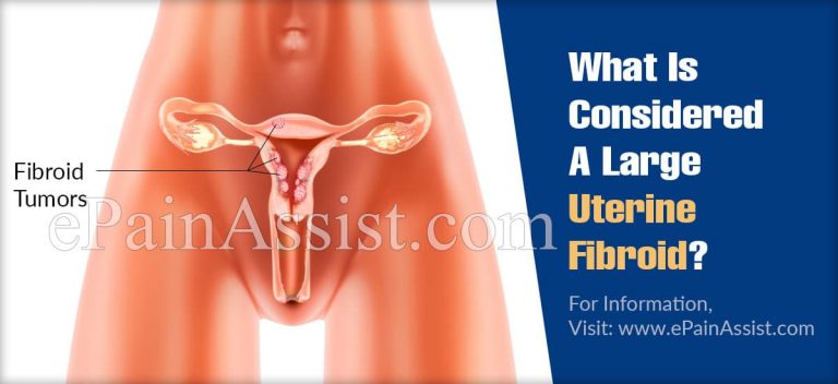 What Is Considered A Large Uterine Fibroid?