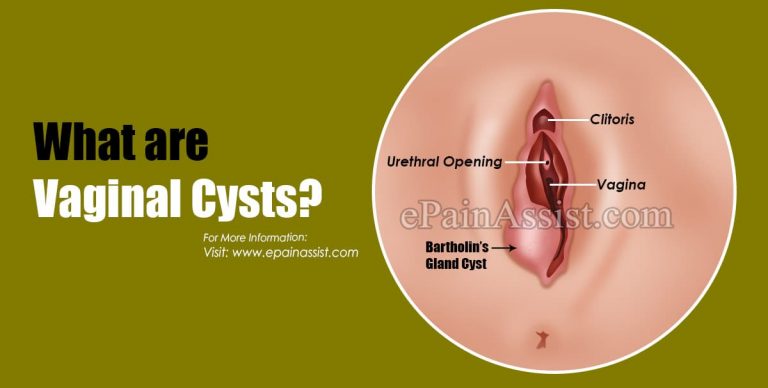 Vaginal Cysts:  Causes & Treatment
