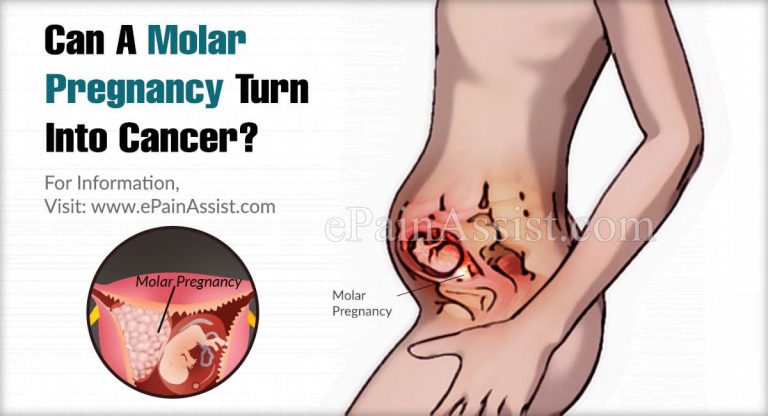 Can A Molar Pregnancy Turn Into Cancer?