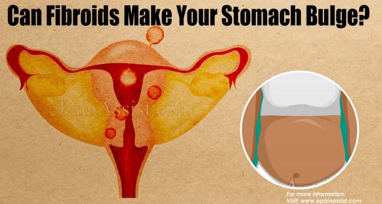 Can Fibroids Make Your Stomach Bulge?