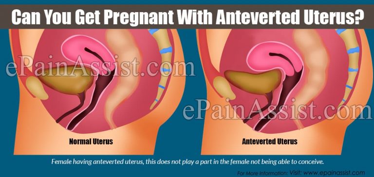 Can You Get Pregnant With Anteverted Uterus?