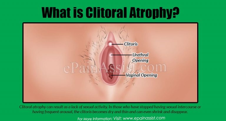 Clitoral Atrophy: Symptoms, Causes, Treatment, Diagnosis