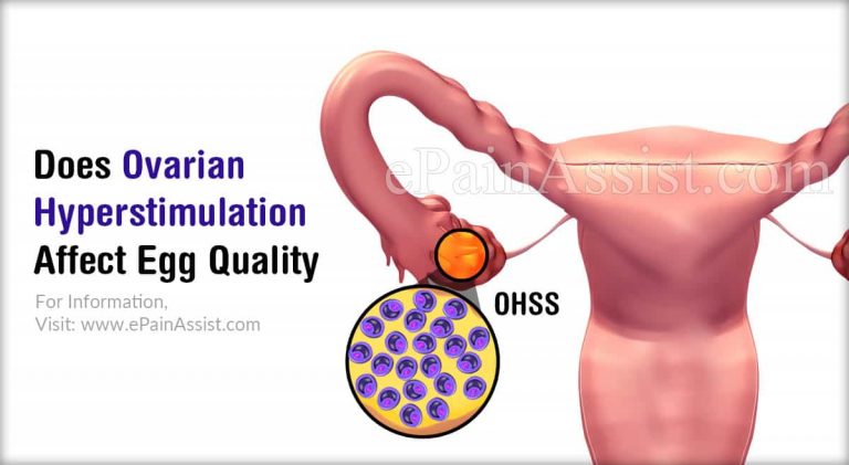Does Ovarian Hyperstimulation Affect Egg Quality & How Do You Get Rid Of OHSS When Pregnant?