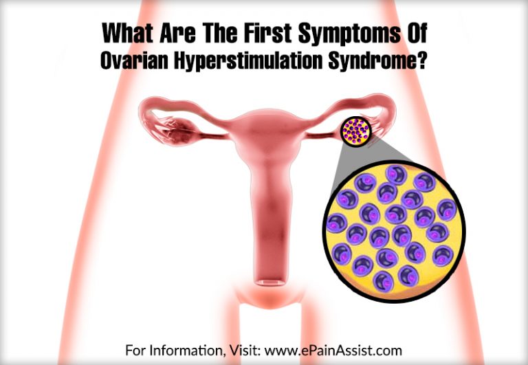 What Are The First Symptoms Of Ovarian Hyperstimulation Syndrome?