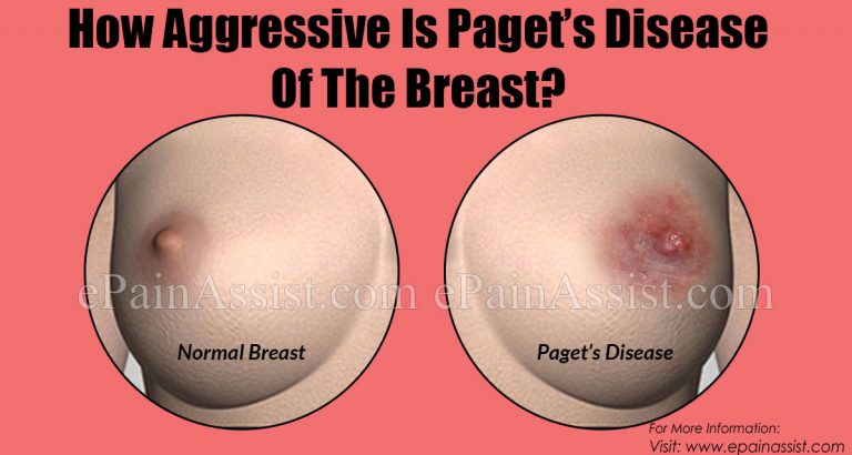 How Dangerous Is Paget’s Disease Of The Breast & Is It Contagious?