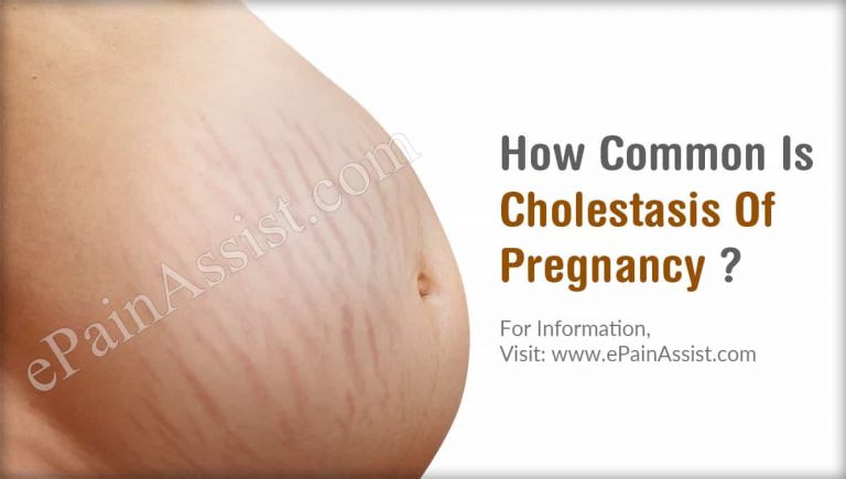 How Common Is Cholestasis Of Pregnancy Or Is It A Rare Disease?