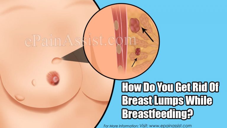 How Do You Get Rid Of Breast Lumps While Breastfeeding?