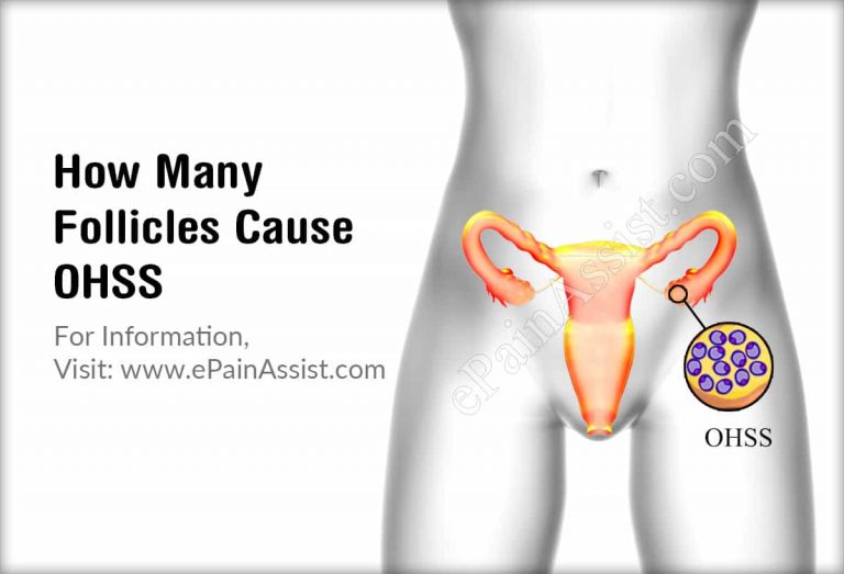 How Many Follicles Cause Ovarian Hyperstimulation Syndrome & What Does OHSS Mean In Pregnancy?