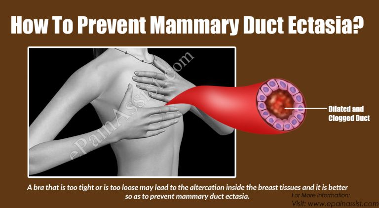 How To Prevent Mammary Duct Ectasia?