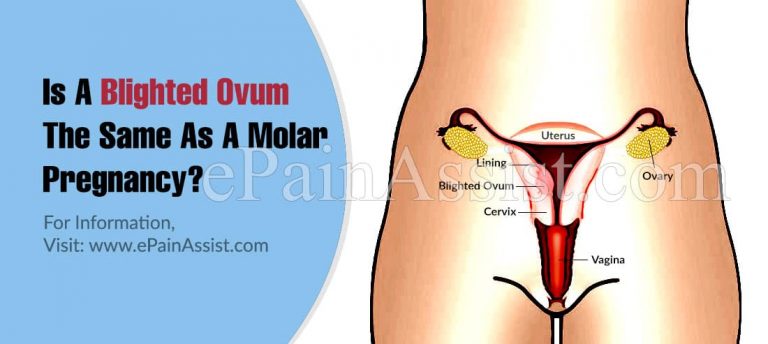 Is A Blighted Ovum The Same As A Molar Pregnancy?