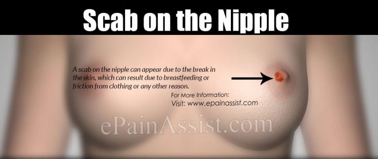 Scab on Nipple: Causes, Treatment and Prevention