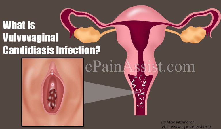 Vulvovaginal Candidiasis Infection: Causes, Symptoms, Treatment, Diagnosis