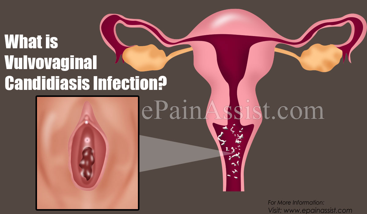 What is Vulvovaginal Candidiasis Infection?