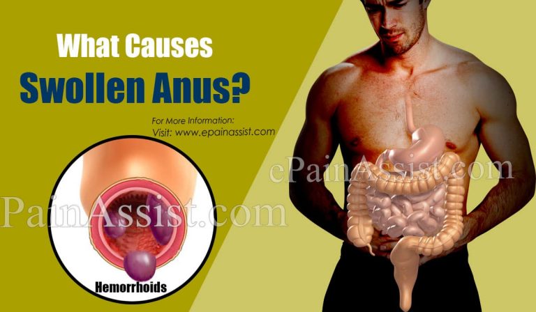 Swollen Anus: Causes, Treatments, Diagnosis